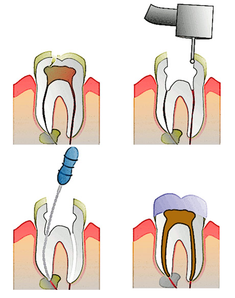 Endodontic Therapy (Root Canal Therapy) - Doctor Manolea